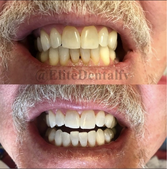 Close up of teeth before and after treatment at Elite Dental of Fountain Valley