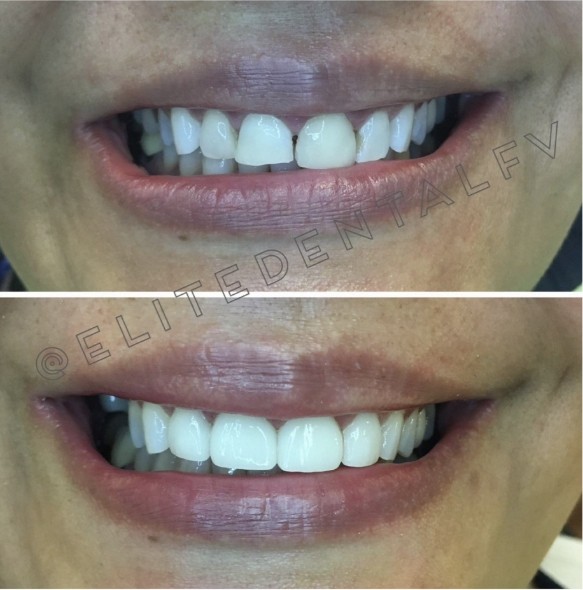 Close up of teeth before and after treatment at Elite Dental of Fountain Valley