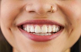 Closeup of woman’s smile with clear aligners over upper arch
