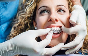 Dentist’s gloved hands placing Invisalign over woman’s upper arch