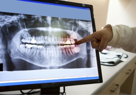 Dentist pointing to computer screen showing digital dental x rays of teeth