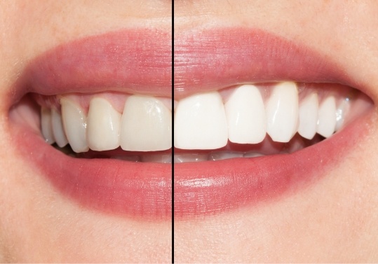 Side by side view of teeth before and after teeth whitening