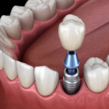 Animated dental implant with dental crown replacing one missing tooth