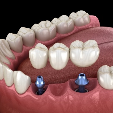 Two animated dental implants with dental bridge