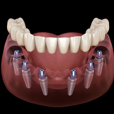 Six animated dental implants with full implant denture
