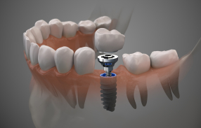 Animated dental implant with dental crown in the lower jaw