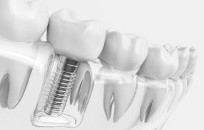 Animated dental crown being placed over dental implant
