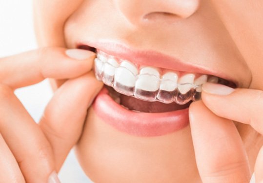 Close-up of woman’s mouth with Invisalign tray