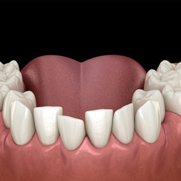 Illustration of crowded teeth in lower dental arch