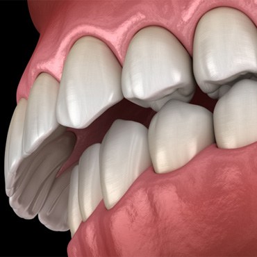 Illustration of overbite against dark background