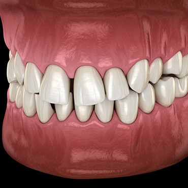 Illustration of gapped teeth