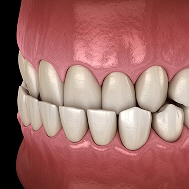 Illustration of an underbite