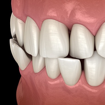Illustration of a crossbite