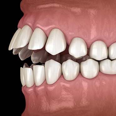 Illustration of an open bite