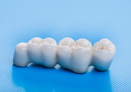 Dental bridge against pale blue background