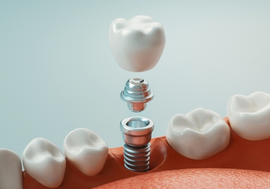 Animated dental implant with dental crown replacing a missing tooth