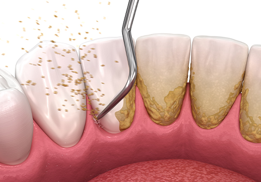 Animated dental instrument removing plaque buildup from the teeth