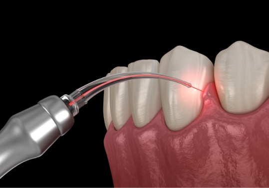 Animated soft tissue laser treating gum disease