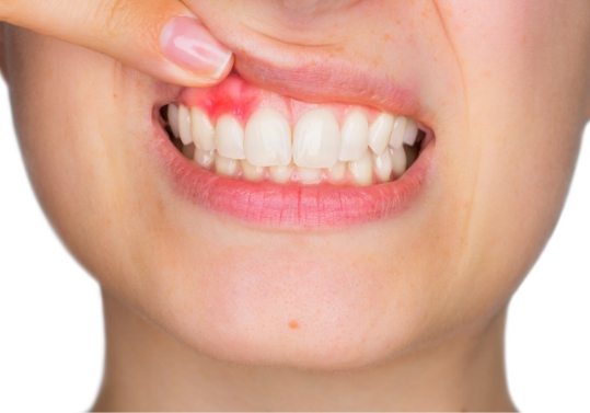 Close up of person pointing to red spot in their gums