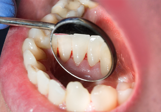 Close up of dental mirror inside of mouth