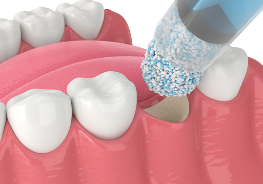 Animated dental bone grafting material being placed in jawbone after tooth extraction