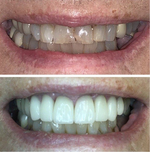 Close up of teeth before and after treatment at Elite Dental of Fountain Valley