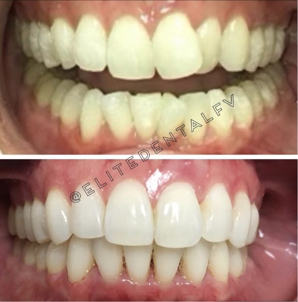 Close up of teeth before and after treatment at Elite Dental of Fountain Valley