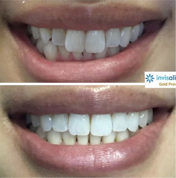 Close up of teeth before and after treatment at Elite Dental of Fountain Valley