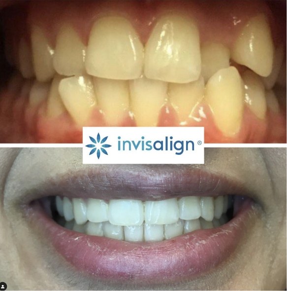 Close up of teeth before and after treatment at Elite Dental of Fountain Valley