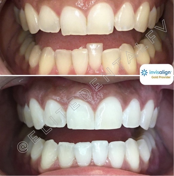 Close up of teeth before and after treatment at Elite Dental of Fountain Valley