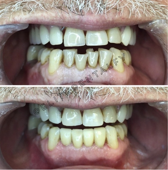 Close up of teeth before and after treatment at Elite Dental of Fountain Valley