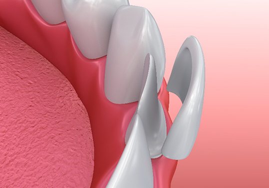 Illustration of veneer being placed on lower front tooth